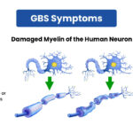 Guillain-Barre syndrome acuate or chronic