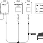 plasma exchange